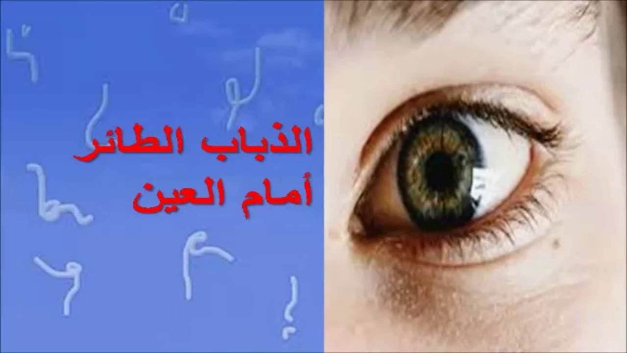 رؤية خيوط سوداء امام العين - علاج فعال لرؤية الخيوط امام العين 4091 1