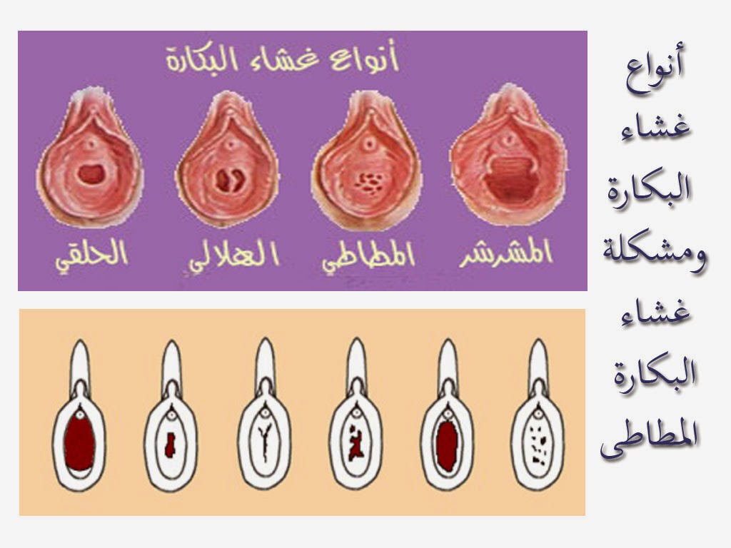 فض غشاء البكارة - غشاء حماية الفتاة 6085 2