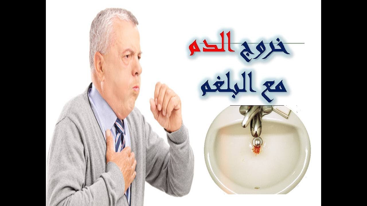 بصق دم عند الاستيقاظ من النوم , علاج فعال لبصق الدم في الصباح