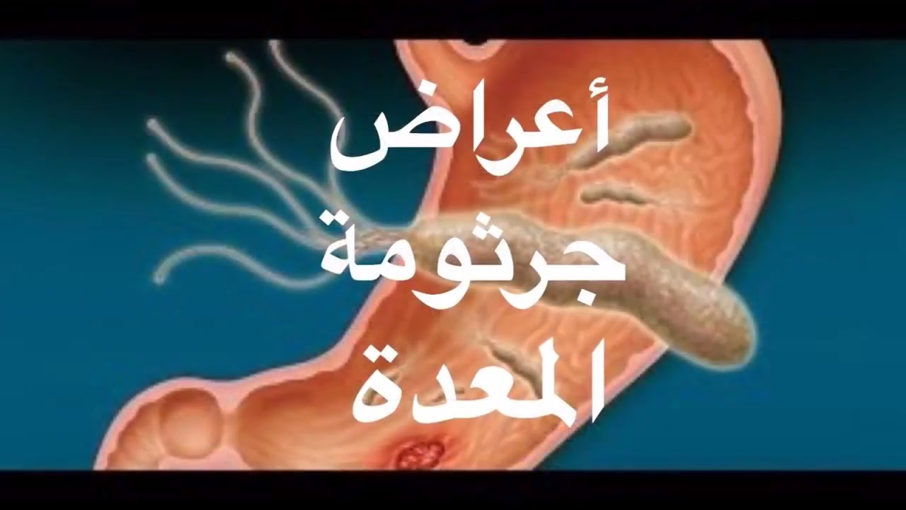 ماهي اسباب جرثومة المعده - اسهل طريقه لعلاج جرثومه المعده 5736 2