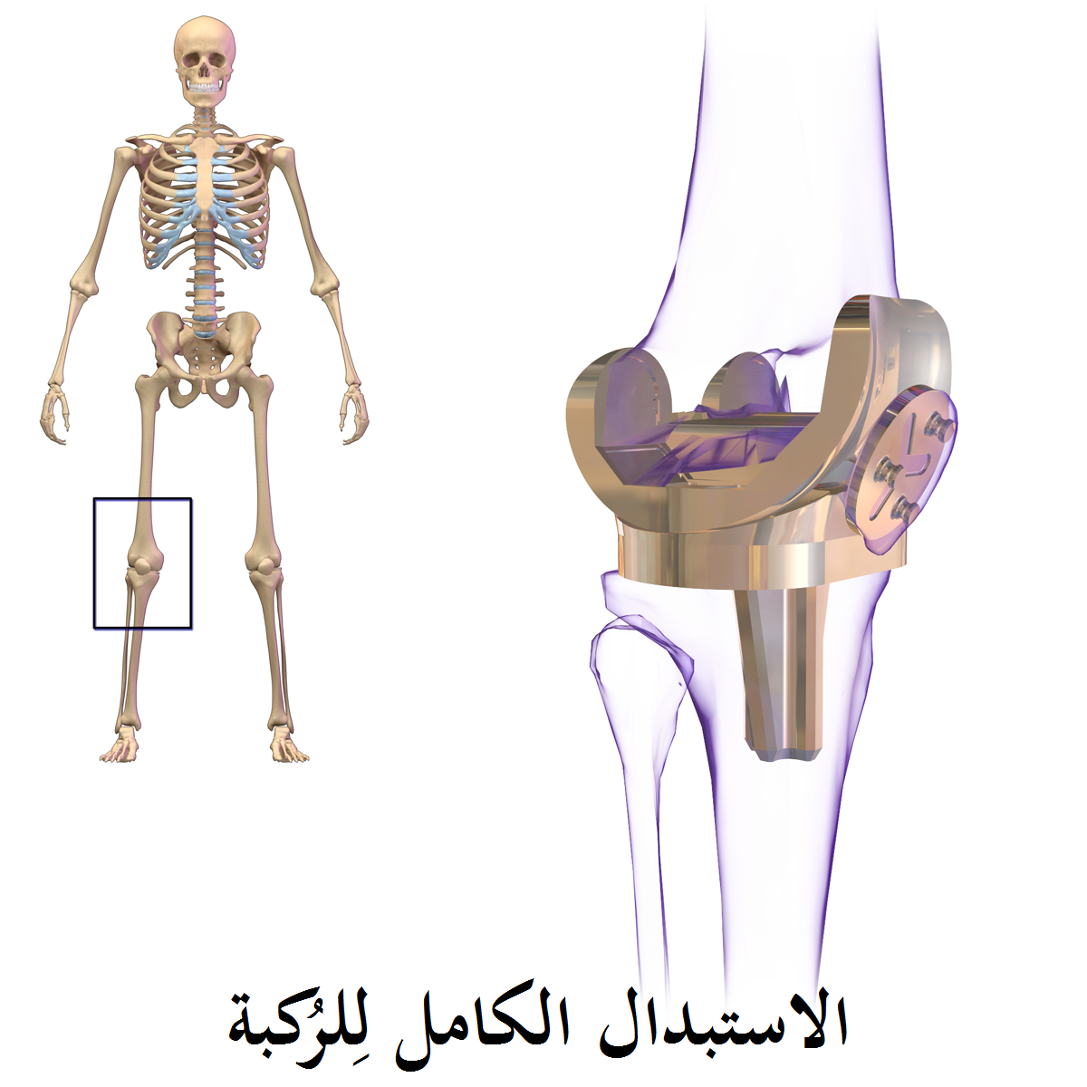 اضرار عملية تغيير مفصل الركبة - مخاطر يجب ان تعرفها 853 1