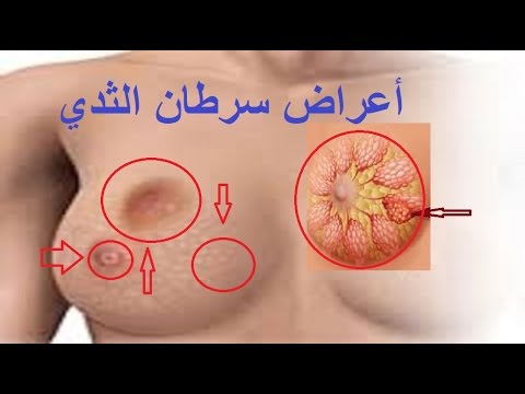 اعراض السرطان عند النساء , علامات على اصابه المراة بالسرطان