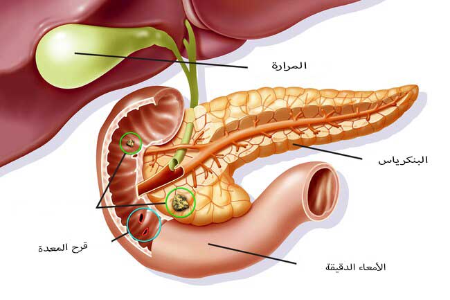 قرحة المعدة وعلاجها , اعراض الاصابه بالقرحه الهضميه وكيفيه معالجتها