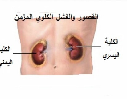 امراض الجهاز البولي - اذى تعرفى امراض الجهاز البولى