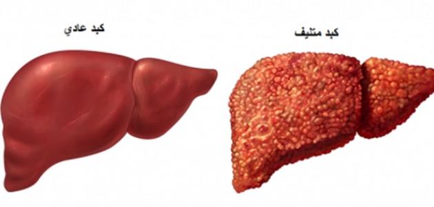 كيف ينتقل فيروس سي , اعراض فيروس سي وسببه