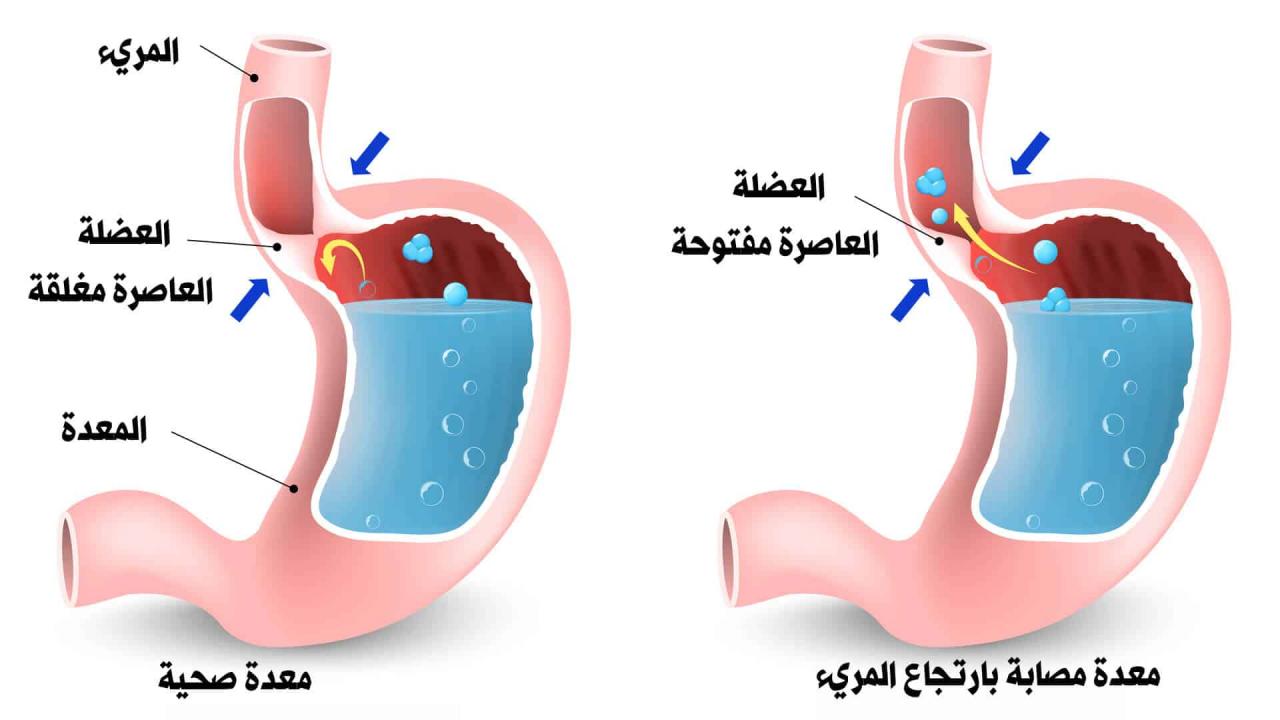 اسباب ارتجاع المرئ , اهم علاج ارتجاع المريئ واعراضه