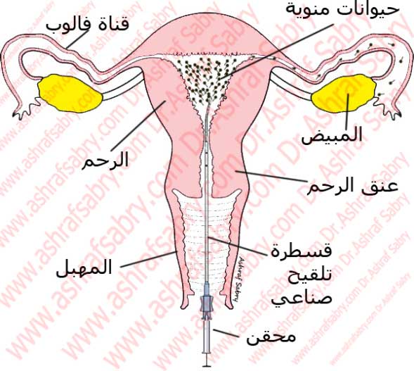 عملية التلقيح الصناعي , مراحل نجاح عملية اطفال الانابيب