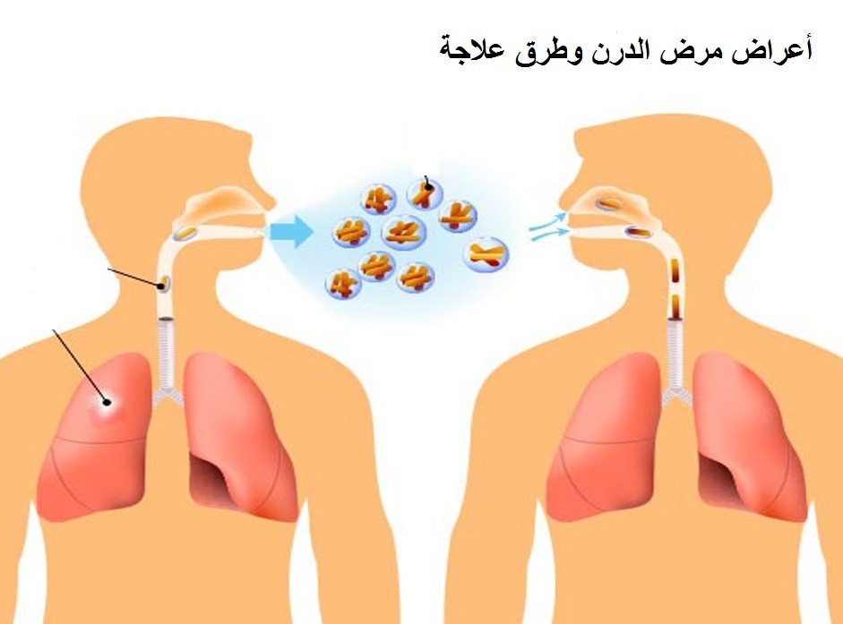 علاج الدرن بالعسل - طرق علاج السل واعراضه 2080 3