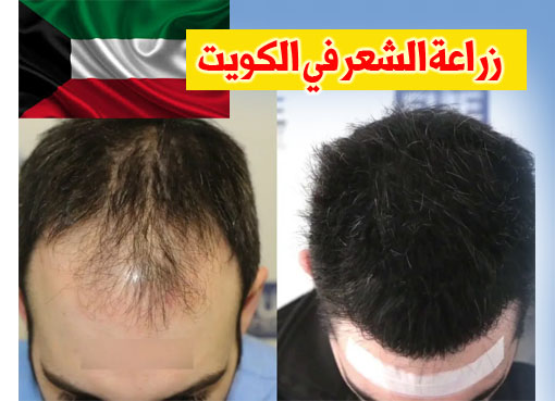 تكلفة زراعة الشعر في الكويت - اسعار زراعة شعر الراس 3251 3