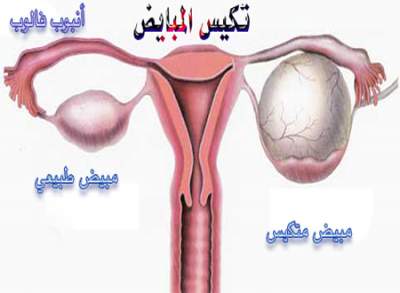 مدة علاج تكيس المبايض البسيط , تكيس المبايض من الامراض الخطيرة