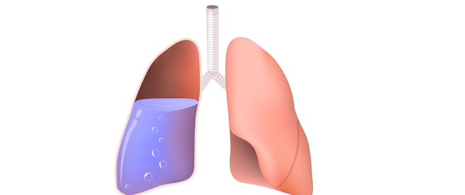 علاج الماء في الرئة , ايه سبب المشكلة دى