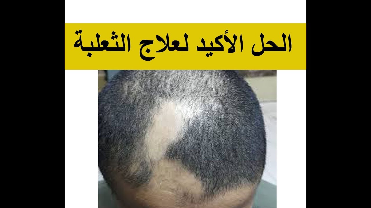 طريقة علاج الثعلبة بالثوم بالصور , طريقه الثوم السليمه لعلاج الثعلبه