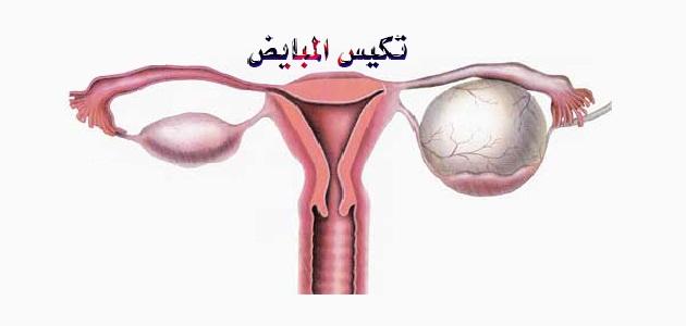 كيف اعرف عندي تكيس في المبايض - اربع علامات لتكيس المبيض 3592 3