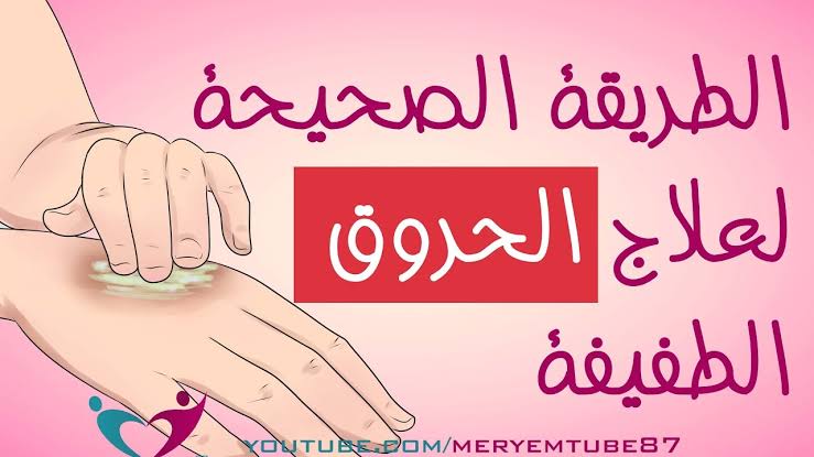 علاج سريع للحروق , اسرع طريقه لعلاج الحروق