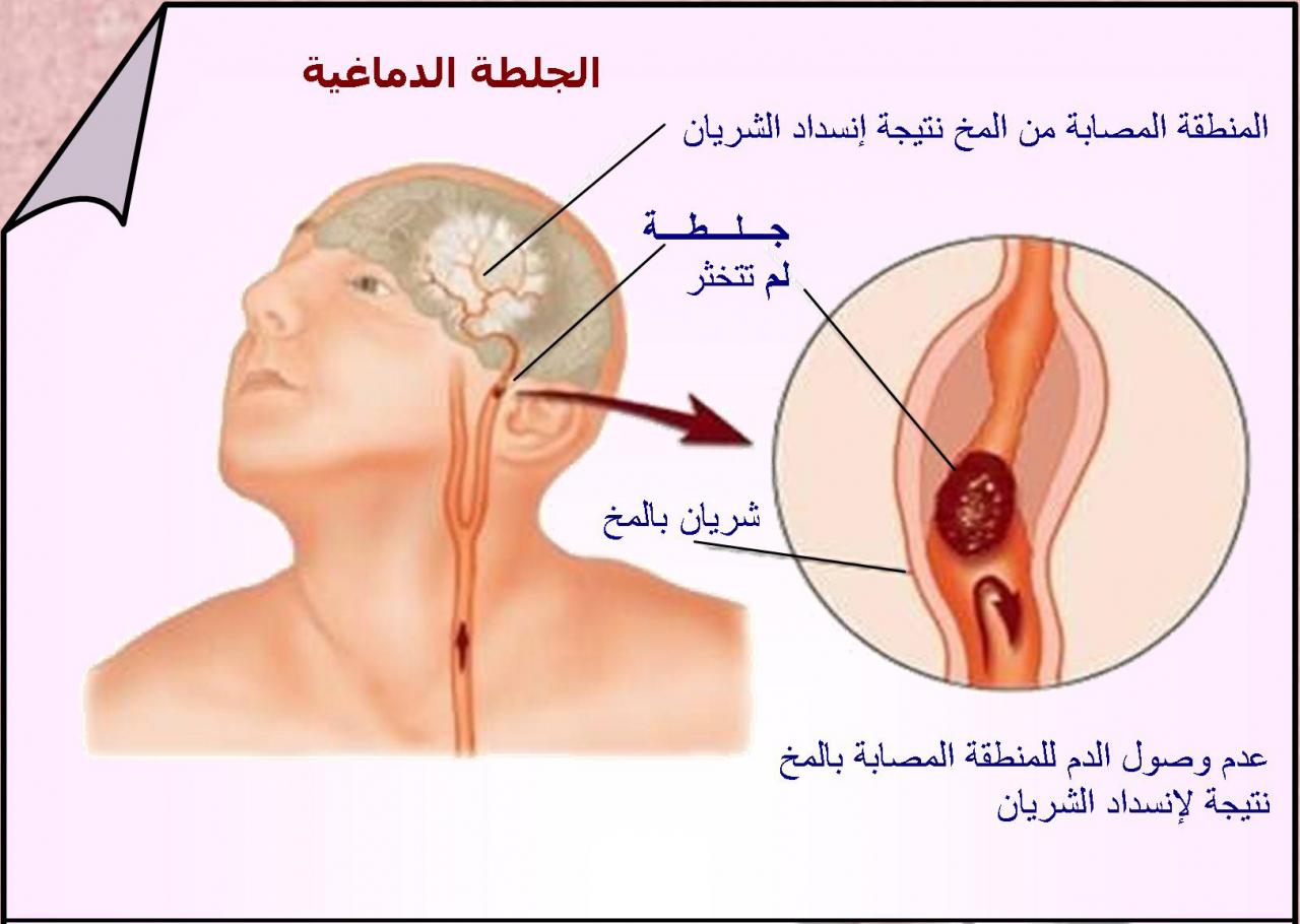 اعراض ما بعد الجلطة الدماغية , بعض المعلومات تفيد فى الوقاية